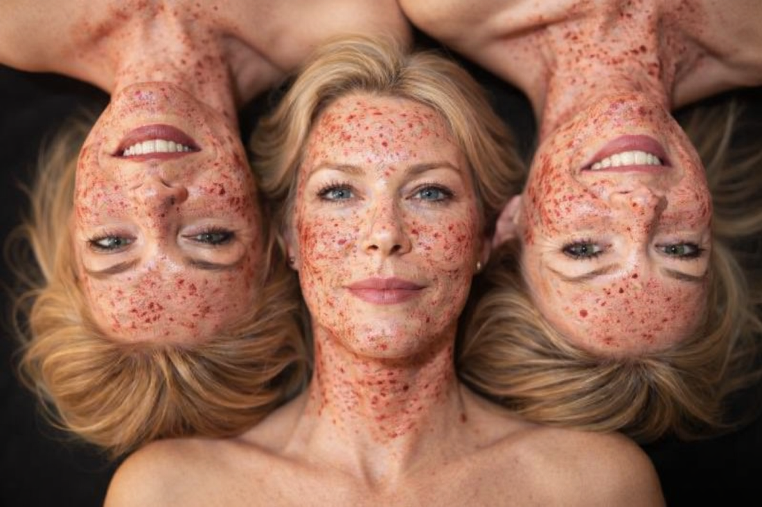What Is PRP? A Naturopathic Doctor Explains Platelet Rich Plasma for Skin, Hair & Joints